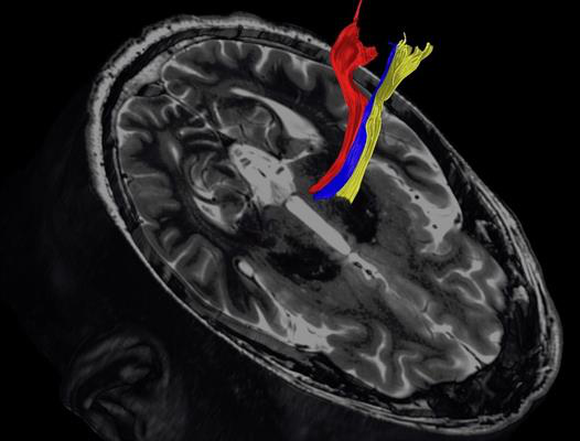 Diffusion tractography uses the movement of water molecules to identify tracts that connect different parts of the brain. It can be used to pinpoint the part of the thalamus to treat with focused ultrasound
