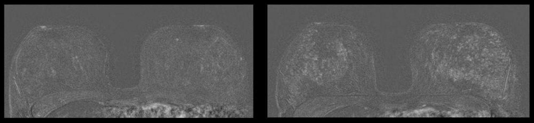Breast MRI of a 41-year-old patient without IUD in place and 27 months later