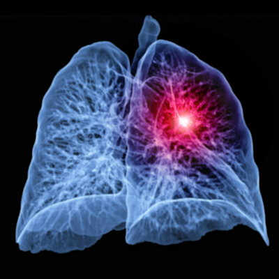 AI could speed up CT lung cancer screening