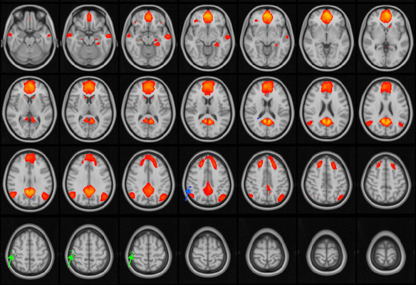 MRI images of the brain with the default mode network highlighted in orange and red