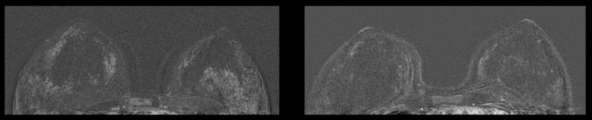 Breast MRI of a 45-year-old patient with IUD in place and 32 months after IUD removal