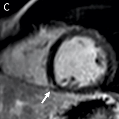 MRI shows late gadolinium enhancement at the right ventricular attachment of a 19-year-old male