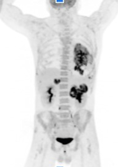 A PET/CT image acquired in two and a half minutes with the Cartesion Prime PET/CT scanner of Canon