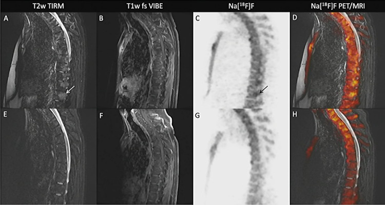 A 40-year-old patient with clinically active r-AxSpA and extensive bone edema on F-18 NaF-PET/MRI at baseline and at four-month follow-up