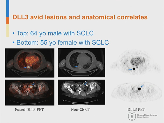 DLL3 avid lesions and anatomical correlates
