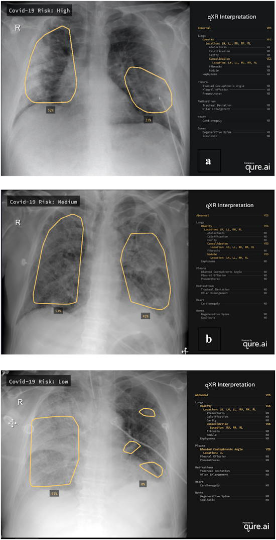 Examples of chest radiographs evaluated by the M-qXR algorithm