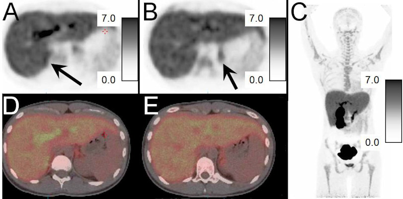 PET/CT images of FNP-59 in a 21-year-old female without adrenal pathology and pretreated with cosyntropin given prior to 6 mCi of F-18 FNP-59