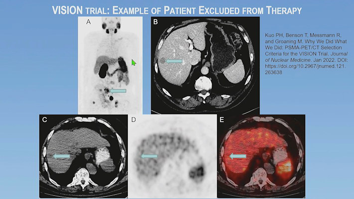 An example of a patient excluded by imaging selection criteria used in the VISION trial
