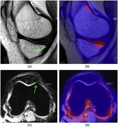 A 30-year-old woman with bilateral knee pain and grade 1 osteophytes in both MT