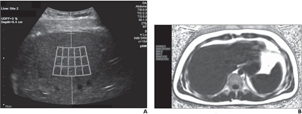  ultrasound-derived fat fraction images of a 23-year-old man with body mass index of 25
