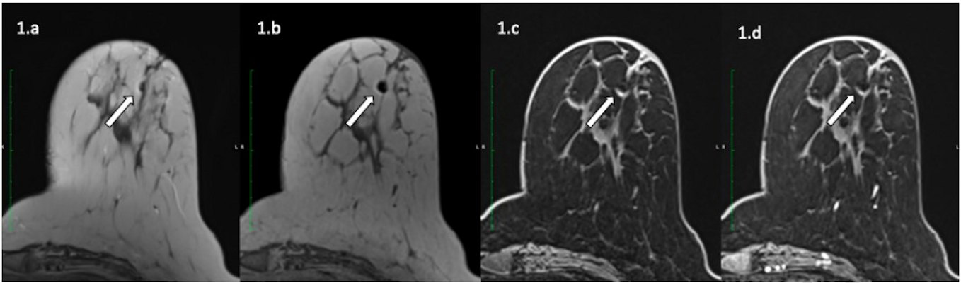 A 57 year old patient with an invasive ductal carcinoma marked by an O Twist metallic marker and treated with neoadjuvant chemotherapy underwent a presurgical MRI on a Siemens 3T with T2-weighted and T1-weighted and 3D T1-weighted Dixon before and after contrast injection