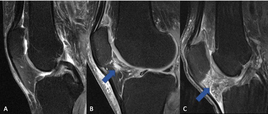 The fat pad adjacent to the kneecap can change in signal on MRI when the knee is inflamed