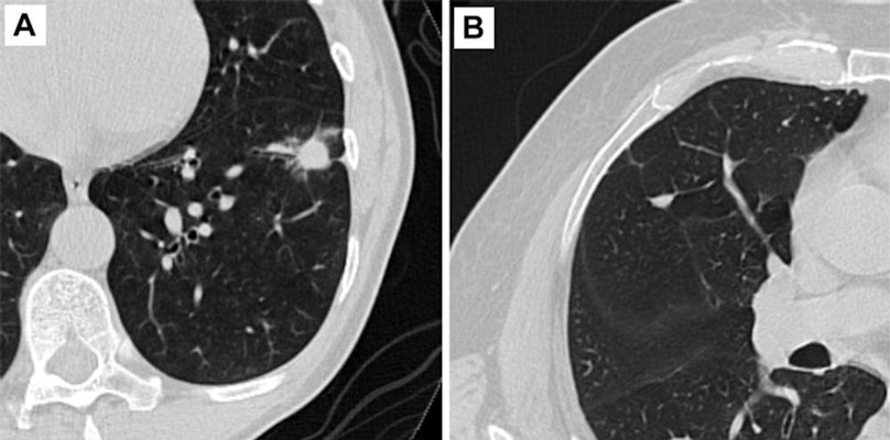 Axial CT images of pulmonary nodules