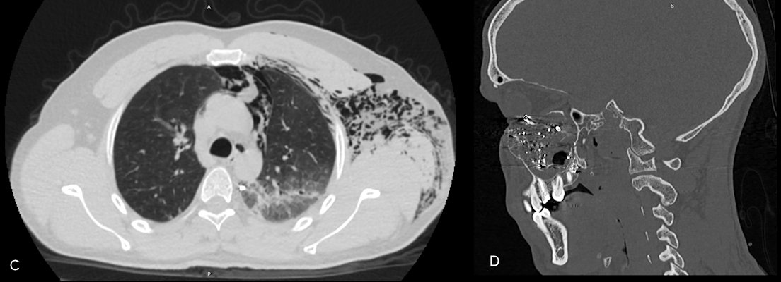Gunshot wound of left orbit and left maxillary sinus with multiple metal pellets and hemosinus and Gunshot wound of left hemithorax