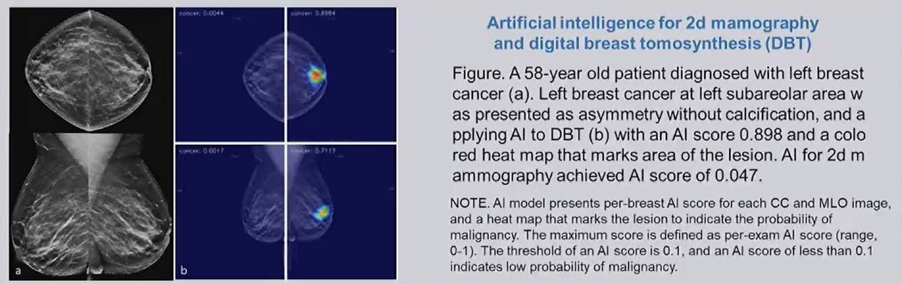 Research led by a team from Lunit showed that AI models using digital breast tomosynthesis perform better than models using digital mammography.
