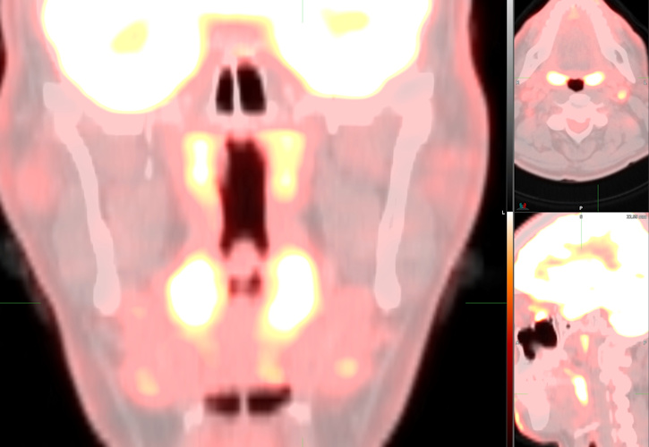 FDG uptake on PET/CT in nasal-associated lymphoid tissue in a cancer patient infected with the COVID-19 omicron variant. 