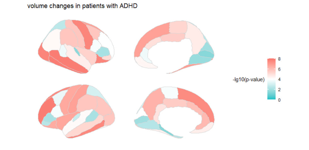 Volume changes in patients with ADHD. Children with ADHD tend to have lower cortical volume, especially in the temporal and frontal lobes