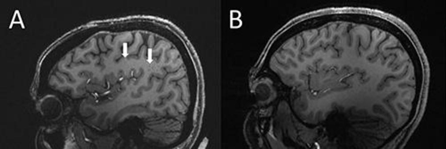(A) Enlarged centrum semiovale perivascular spaces present (arrows) on sagittal T1-weighted MRI in a case with chronic migraine. (B) MRI shows a migraine-free control case without enlarged spaces
